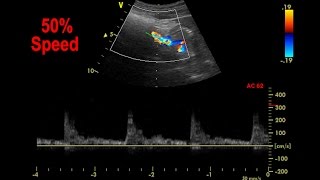 Abdominal Aorta Color Doppler [upl. by Ettenahc]