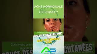 acne hormonale c est quoi [upl. by Coffeng802]