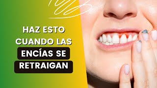 9 Remedios Caseros Para La Retracción De Encías O Recesión GingivalSíntomas De Retracción De Encías [upl. by Iredale874]