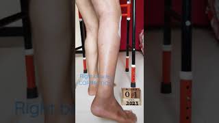 Right bow leg CORRECTION [upl. by Flem]