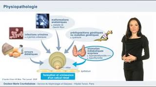 Diagnostic de la lithiase rénale [upl. by Berlauda]