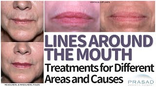 How to Treat Lines Folds and Wrinkles Around the Mouth and Lips [upl. by Novahs]