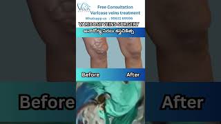 Best Varicose Implications of Varicose Veins telugu VaricoseVeins shorts [upl. by Aleekahs]