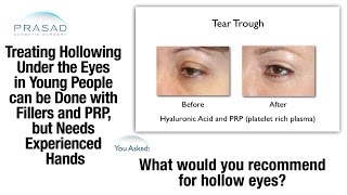 Treating Hollowness Under the Eyes Must be Done Carefully Due to Thinness of Eyelid Skin [upl. by Godspeed]