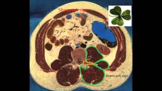 Ultrasound guided Quadratus Lumborum Block QLB1 [upl. by Shay]