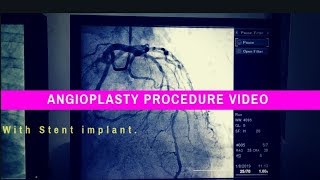 How heart stent inserted  Angioplasty Procedure video of heart  Stent Placement in Heart [upl. by Irakab144]