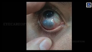 Guess the condition eyecareoptom conjunctiva eye eyeproblem [upl. by Hellene]