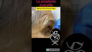 La proptosis pulsatile proptosis oeil docteur sante las pass etudient france hopitale [upl. by Warfore]