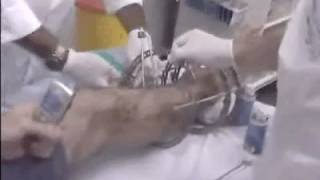 Part 2 External Fixation Removal  Ilizarov to full leg cast [upl. by Neltiac]