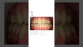 Clear Aligners in Action Watch a Smile Transform Before Your Eyes clearaligners [upl. by Ahsenar]