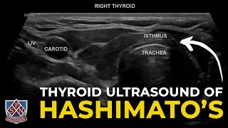 Thyroid Ultrasound of Hashimotos [upl. by Norma]