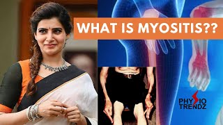 Myositis amp Types How to Treat it With Physiotherapy [upl. by Esya920]