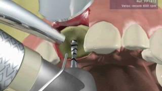 IMPLANTE DENTAL UNITARIO fase quirúrgica [upl. by Luckin]