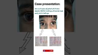 Understand the Megalocornea by a case presentation optometrists optometry optomkunj [upl. by Itram]