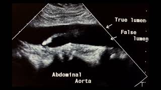 Remaining of dissection flap in abdominal aorta to drahmadmirdamadisi7av5Ellgc1wVFto [upl. by Aleda]