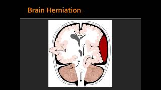 Intracranial Hemorrhage  Epidural Hematoma [upl. by Picker]