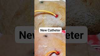 Suprapubic Catheter Replacement spc viralvideo viral satisfying watch foryou love trending [upl. by Clarita772]