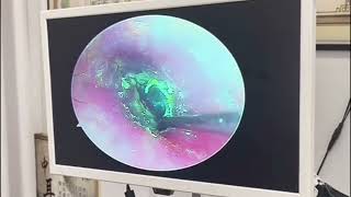 ENDOCSOPIC MUCOID OTITIS MEDIA DRAINAGE earwax Cleaning earwaxremoval satisfying [upl. by Leakcim]