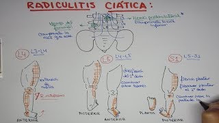 Radiculitis Ciática L4 L5 S1  Hernia de disco lumbar [upl. by Towny402]