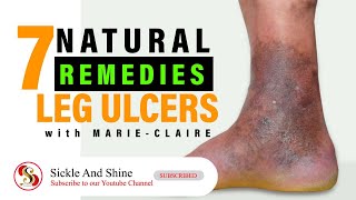 Leg Ulcer Remedies [upl. by Chantalle68]