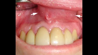 Odontogenic cyst insinuating a nasolabial cyst [upl. by Duile]