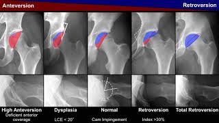 S Steppacher Pelvic incidence in acetabular retroversion Hip Symposium 2018 [upl. by Oralle]