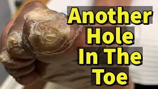 Another Hole In The Toe Ulcer Fungal Toenails and Calluses [upl. by Nylirac]