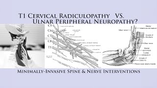 How to Differentiate T1 Cervical Radiculopathy vs Ulnar Nerve Neuropathy Cubital Tunnel Syndrome [upl. by Parshall]