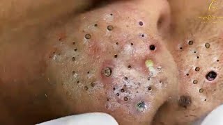 Big Cystic Acne Blackheads Extraction Blackheads amp Milia Whiteheads Removal Pimple Popping  5165 [upl. by Lalo]