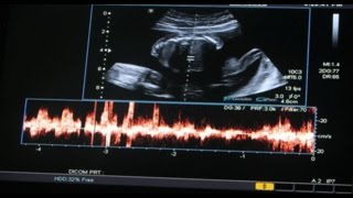 ULTRASOUND  19 WEEKS amp 6 DAYS [upl. by Leavelle]