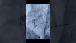 Coronary sinus decapolar lead insertion in EPI study [upl. by Kaule581]