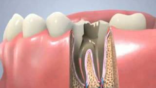 Traitement de canal traitement endodontique [upl. by Carmelia868]