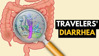 Travelers diarrhea Causes Signs and Symptoms Diagnosis and Treatment [upl. by Eessac]