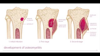 Osteomyelitis Of Bone In Hindi  part 1 [upl. by Neille]