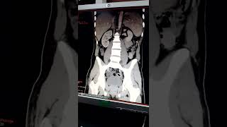 ctscan radiography photo venous phase ct [upl. by Geldens]