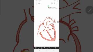 Constrictive Pericarditis  ventricular discordance expiratory hepatic vein flow reversal [upl. by Nav]