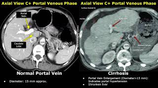 CT Liver Normal Vs Cirrhosis Images  Irregular Margins Splenomegaly Portal Hypertension Ascites [upl. by Eelsnia]