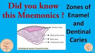 Mnemonics  Histological Zones of Enamel and Dentinal Caries [upl. by Arob]