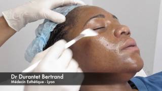 Peeling superficiel antiacné  Alpha Béta Complex de Méné amp Moy par le Dr Durantet Lyon [upl. by Ttirb]