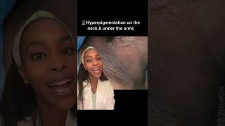 How to get rid of hyperpigmentation on the neck and under the arms [upl. by Evita]