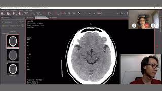 Avaliação por neuroimagem das herniações cerebrais  Parte 2 [upl. by Airelav382]