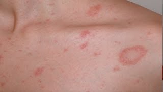 Pityriasis rosea English version [upl. by Orvas184]