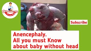 ANENCEPHALY All you must know about baby without Head [upl. by Aisined]