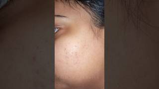 adapalene gelhow I used to cure my acne [upl. by Anana]