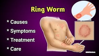 Ring Worm Causes symptoms and Treatment [upl. by Tegan]