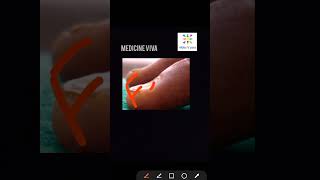 Medicine Koilonychia spoon nail iron deficiency anemia [upl. by Janka]