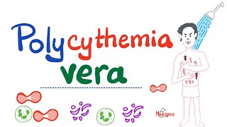 Polycythemia Vera PV  Myeloproliferative Neoplasm MPN  Erythrocytosis  Hematology [upl. by Eilatam]