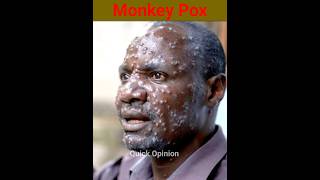 M pox Virus Monkey Pox New Virus shorts facts mpox [upl. by Lavella]