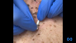 Large Blackheads on the Back [upl. by Adnawal]