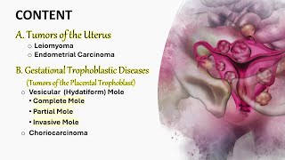 Female genital tumors II Uterus and Trophoblast شرح محاضرة [upl. by Hull]